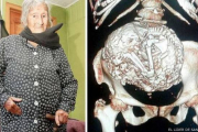 Al hacerle una radiografía a Estela, apareció una imagen que es propia de la columna vertebral de un feto.-Foto:   EL LÍDER DE SAN ANTONIO