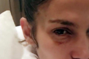 Jennifer Lopez, con el ojo morado.-INSTAGRAM