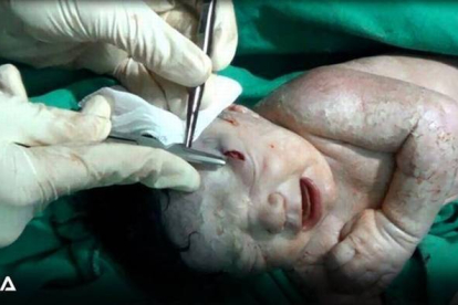 El bebé en la operación para extraerle el pedazo de metralla.-