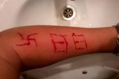 Imagen del brazo del jóven tras la agresión con la esvástica y el número 88 marcados.-@ANTIFAXISMOA