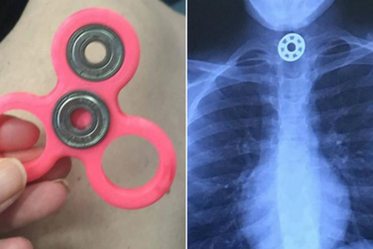 El Fidget Spinner y la radiografía en la que se aprecia la pieza del juguete en el esófago de la niña.-FACEBOOK