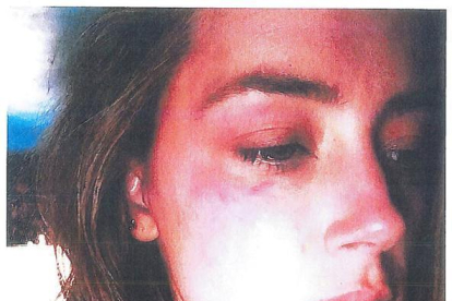 Amber Heard, con las heridas en el rostro que le causó Johnny Depp al lanzarle un teléfono.-REUTERS