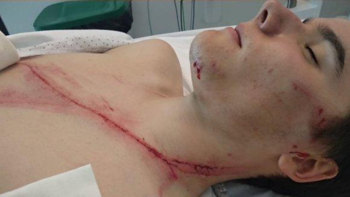 Andoni Azkarate con la herida que se produjo tras impactar con un guardarraíl en el Campeonato de Euskadi de ciclismo amateur.-DAVID ETXEBARRIA