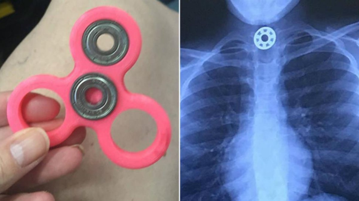 El Fidget Spinner y la radiografía en la que se aprecia la pieza del juguete en el esófago de la niña.-FACEBOOK