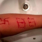 Imagen del brazo del jóven tras la agresión con la esvástica y el número 88 marcados.-@ANTIFAXISMOA