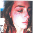 Amber Heard, con las heridas en el rostro que le causó Johnny Depp al lanzarle un teléfono.-REUTERS