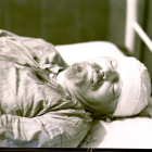Trotsky, en el hospital, tras sufrir el ataque de Ramón Mercader-