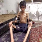 Desnutrición 8Manifestantes con la imagen de un niño, supuestamente de Madaya, en una protesta en Beirut. A la derecha, una foto distribuida por el Consejo Revolucionario de Madaya.-EFE / NABIL MOUNZER - CONSEJO REVOLUCIONARIO MADAYA / AP
