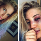 Anastasia Yankova, en sendas imágenes colgadas en su cuenta de Instagram, antes y después de la pelea.-INSTAGRAM