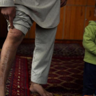 Mohammed muestra sus cicatrices junto a Zamir, su hijo menor.-WAKIL KOHSAR
