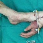 Los cirujanos injertaron la mano en su pierna para mantener el flujo sanguineo.-Foto: CANAL DE TV XXCB