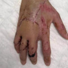 La mano de Bruno Hortelano, reestructurada por el doctor Xavier Mir.-EL PERIÓDICO