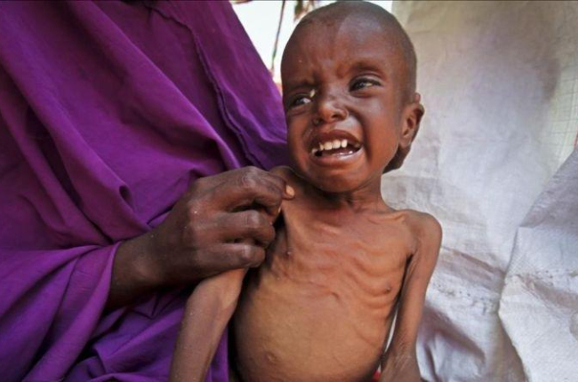Un niño somalí de 7 años que padece malnutrición en el campo de desplazados de Garasbaley, a las afueras de Mogadiscio, la capital de Somalia.-AP / FARAH ABDI WARSAMEH