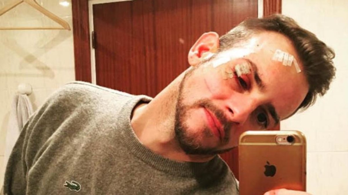 Àlex Casademunt muestra su rostro con múltiples heridas, tras sufrir una agresión el pasado 15 de enero en una discoteca de Vigo-INSTAGRAM