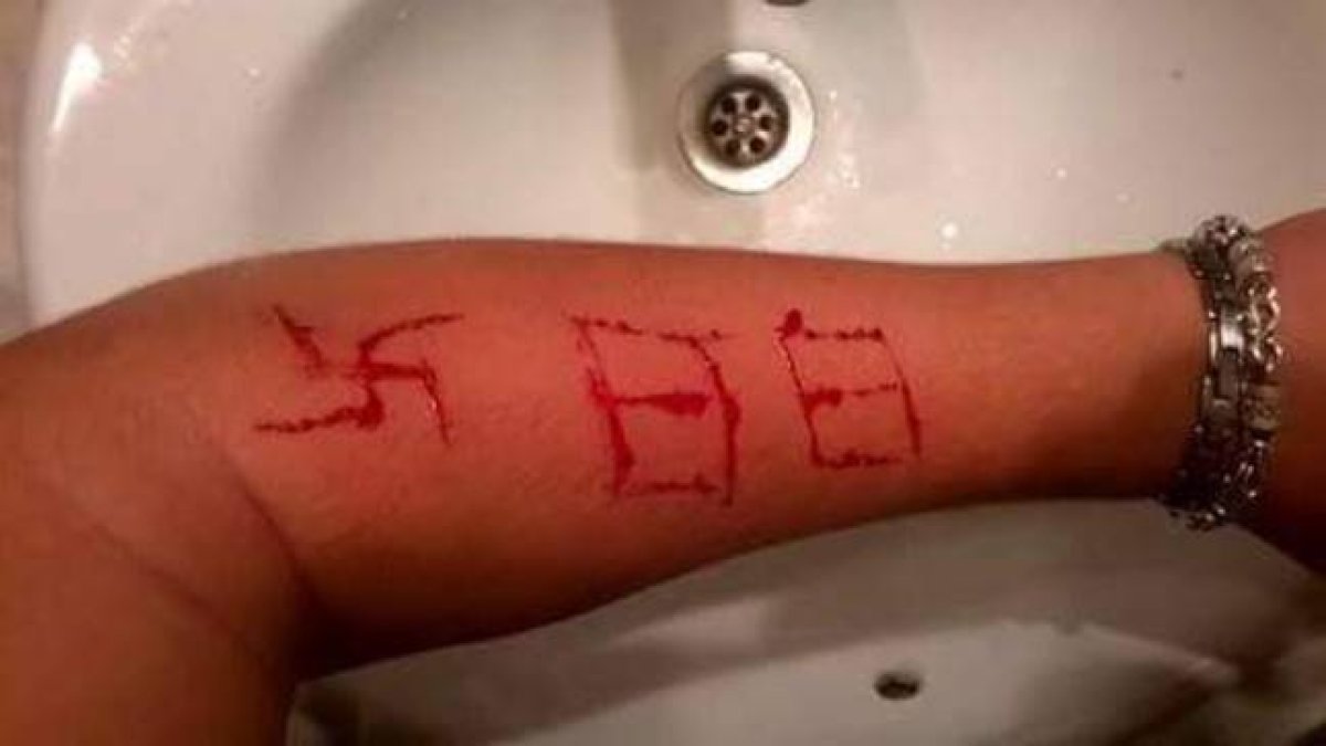 Imagen del brazo del jóven tras la agresión con la esvástica y el número 88 marcados.-@ANTIFAXISMOA