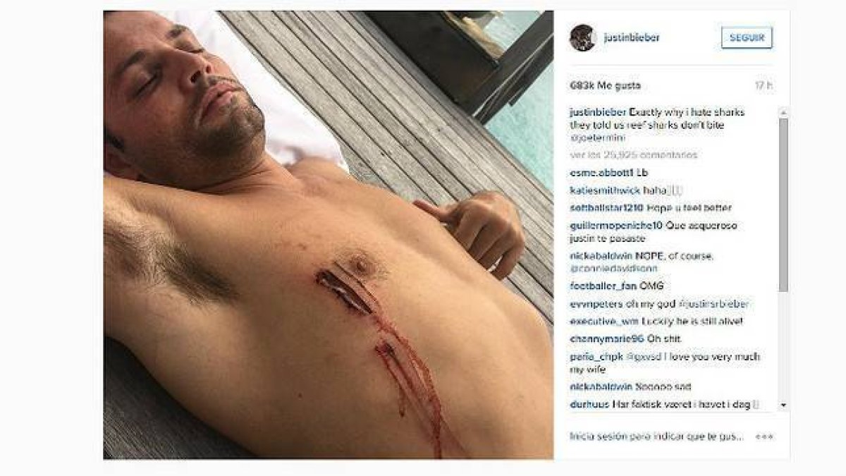 El amigo de Justin Bieber con la herida causada por el tiburón.-Foto: INSTAGRAM