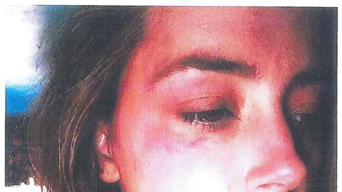 Amber Heard, con las heridas en el rostro que le causó Johnny Depp al lanzarle un teléfono.-REUTERS