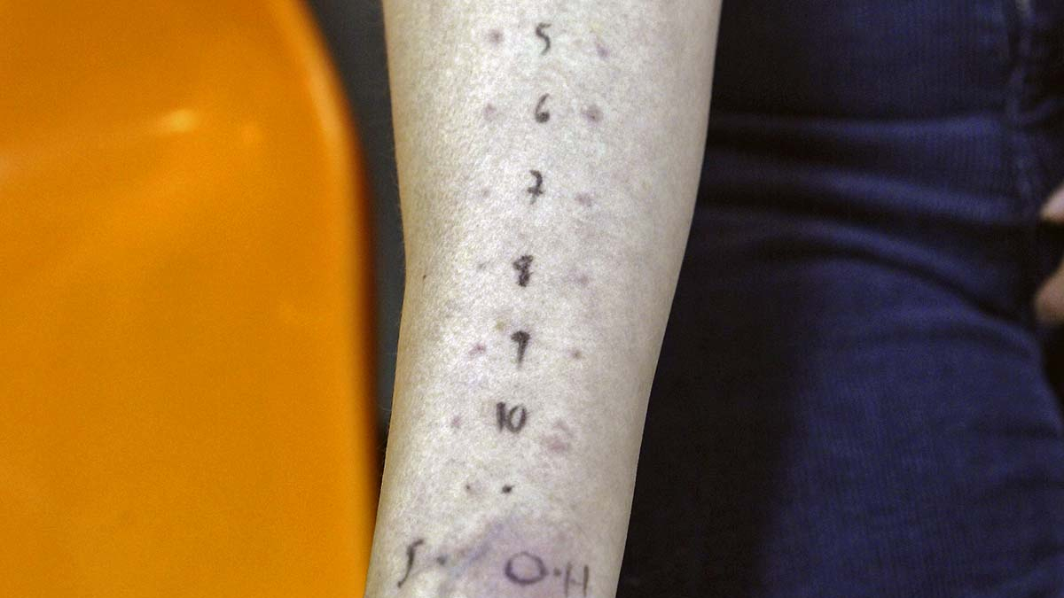 Prueba de alergia.