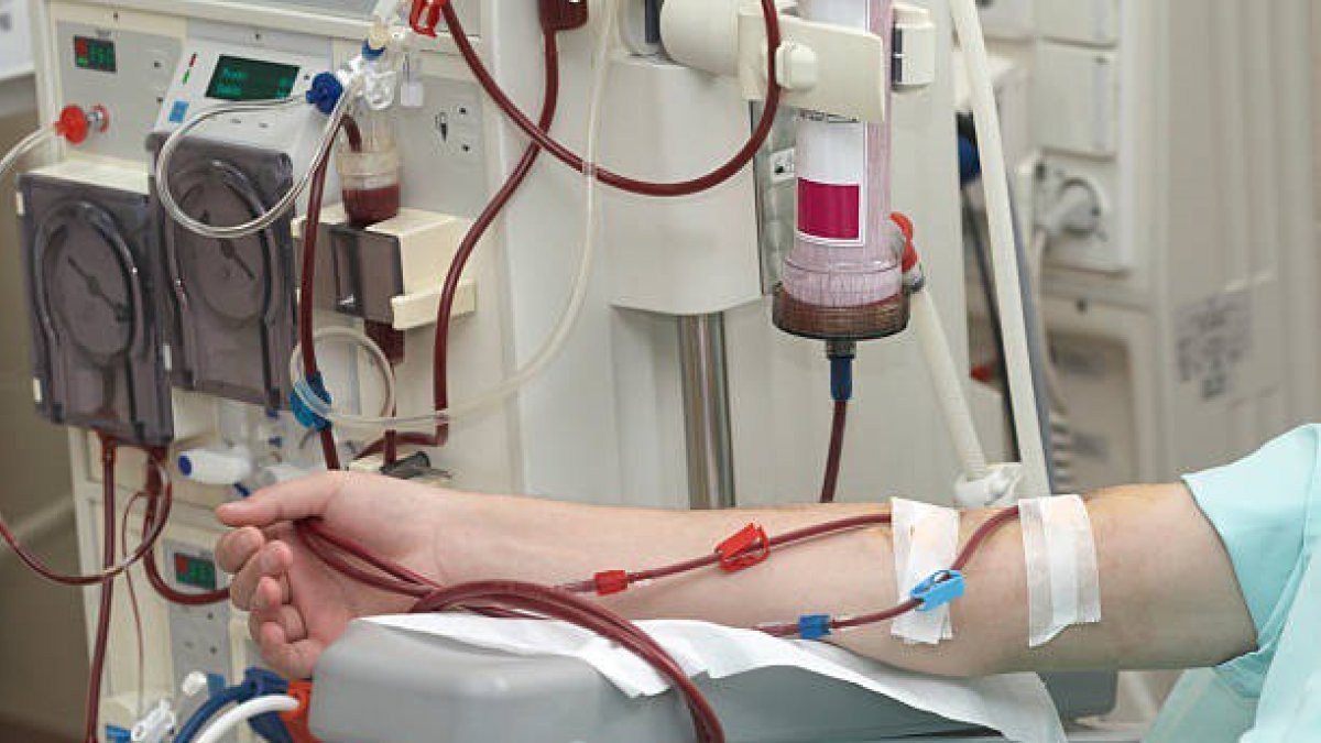 Paciente recibiendo diálisis.
